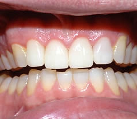 After: close-up of John T.'s teeth and healthy pink gums