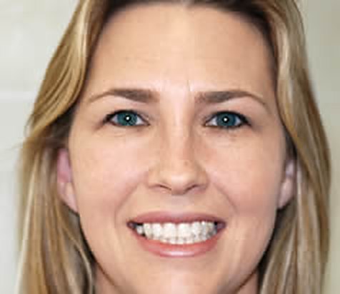 Before: Kristin D., uneven front teeth