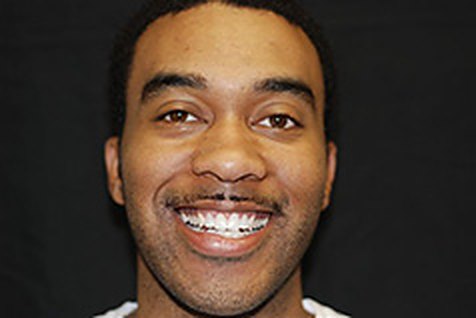 After: crowns by Dr. Mastro, a natural-looking smile, not retouched