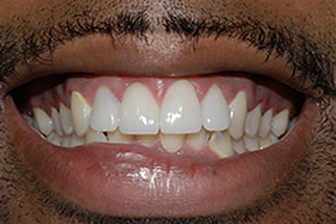 After: crowns by Dr. Mastro, close-up of an even, natural-looking smile