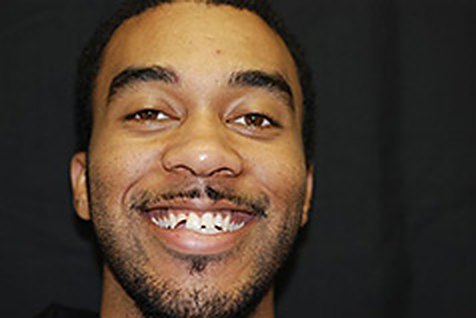 Before: his patient's smile with crowded, uneven front teeth