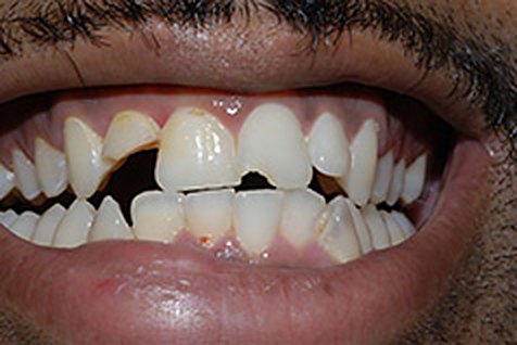 Before: same patient, crowded and gapped front teeth